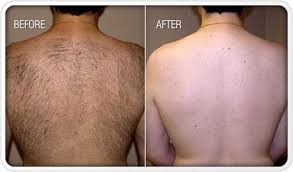 Permanent hair removal